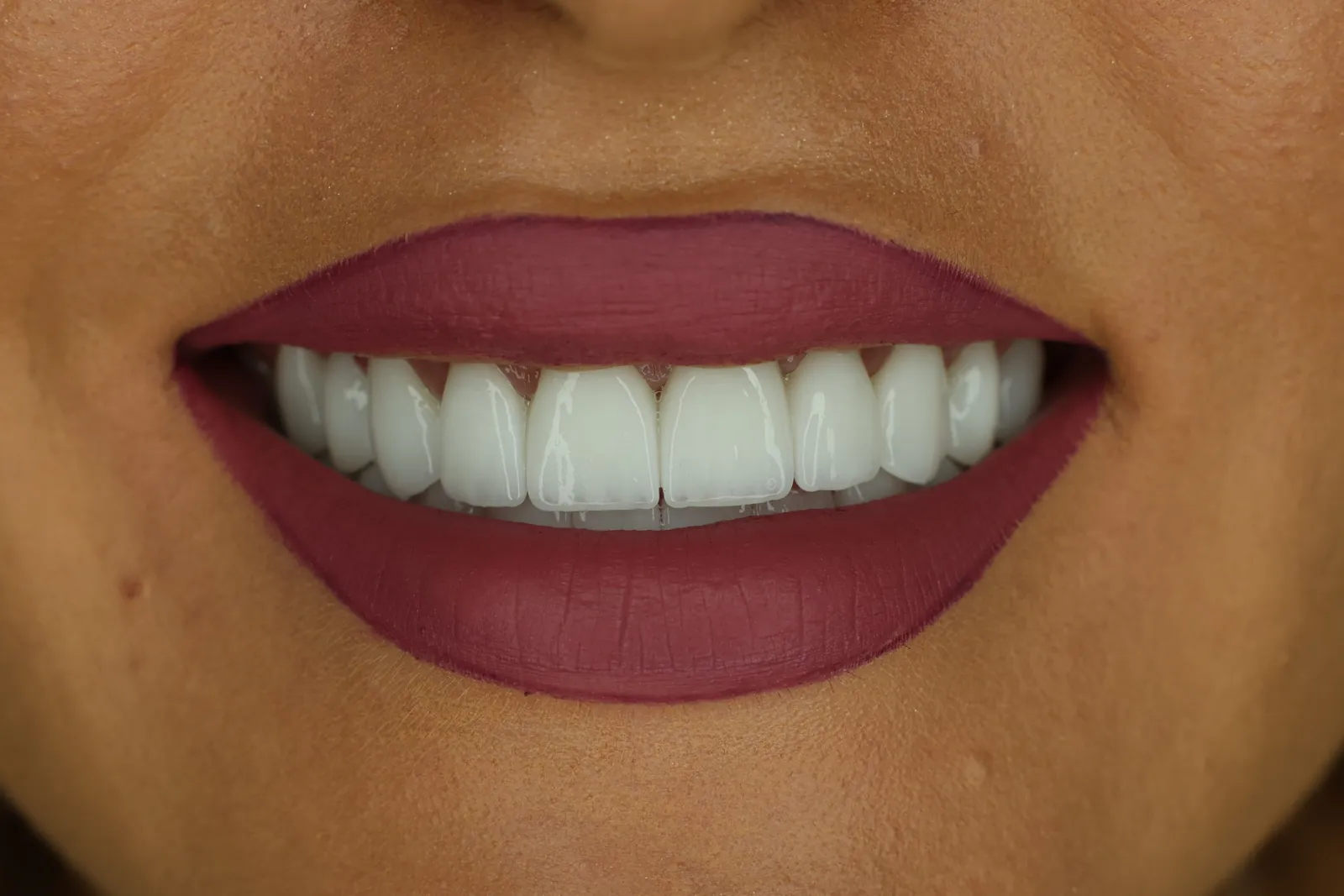 Un sorriso con corone in ceramica, da un caso documentato DentalCare One