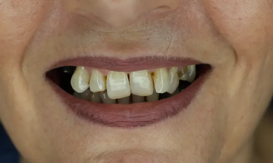 Denti usurati e scuriti prima del trattamento con impianti e corone