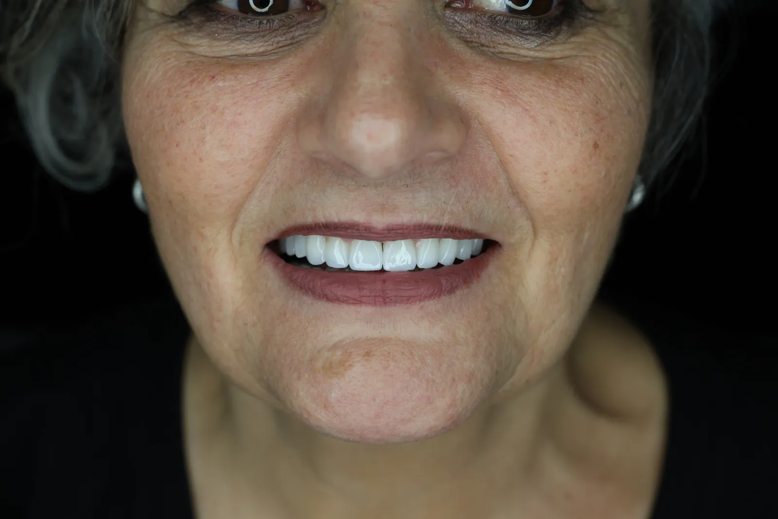 Il sorriso dopo impianti e corone, da un caso documentato DentalCare One