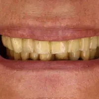 I denti della paziente prima