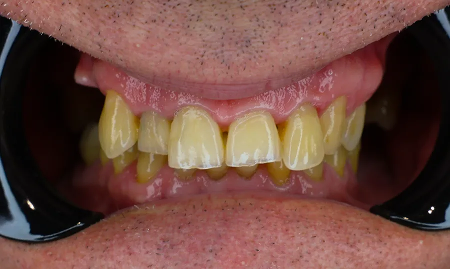 I denti del paziente prima del trattamento a Tirana
