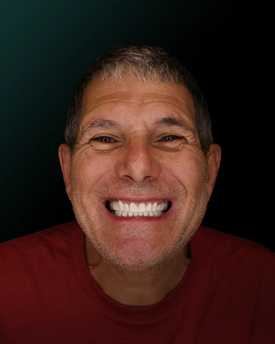 Il sorriso del paziente dopo la riabilitazione con corone in ceramica
