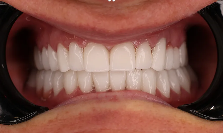 Gli stessi denti dopo il trattamento a Tirana
