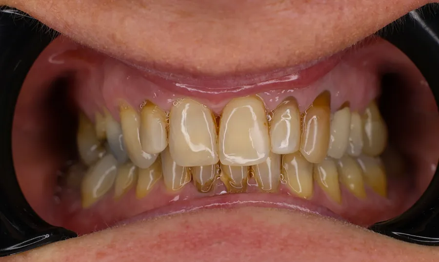 I denti del paziente prima del trattamento nella clinica DentalCare One di Tirana