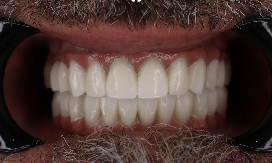 Gli stessi denti dopo il trattamento a Tirana