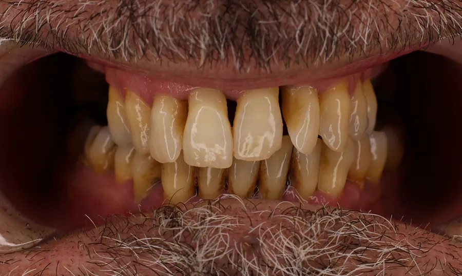 I denti del paziente prima del trattamento nella clinica DentalCare One di Tirana