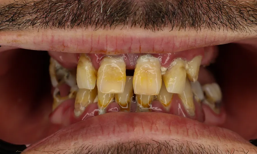 Denti del paziente prima del trattamento, gravemente compromessi dalla carie
