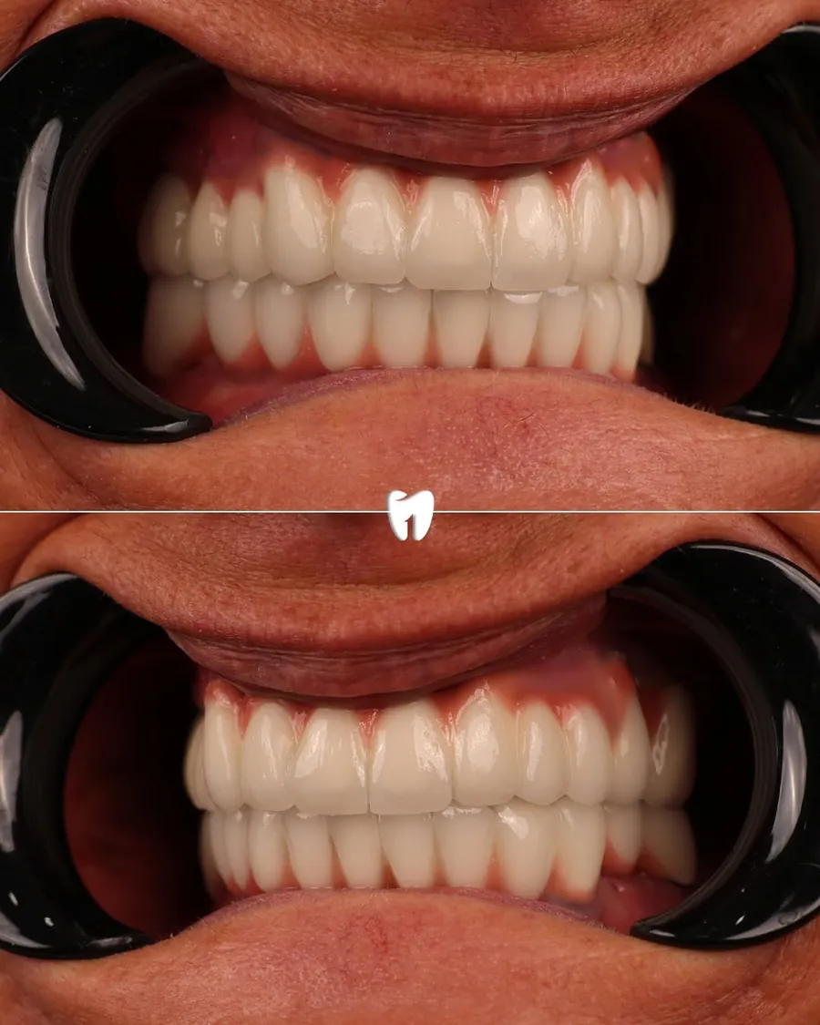 Riabilitazione completa con corone in zirconia eseguita a Tirana