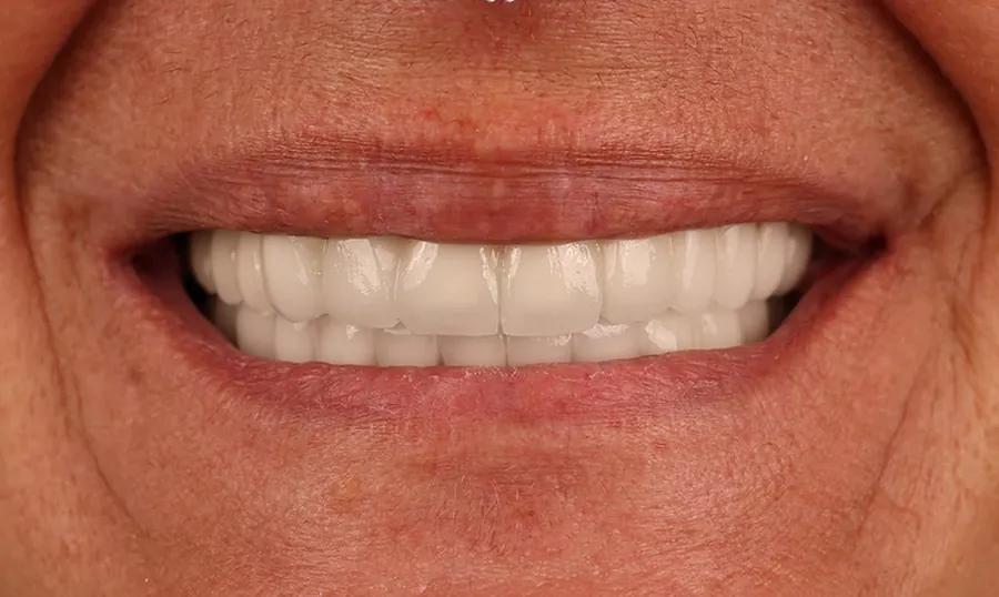La stessa bocca dopo un impianto e 24 corone in zirconia